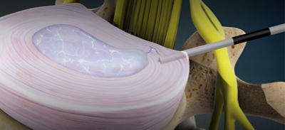 Percutaneous Disc System Stryker